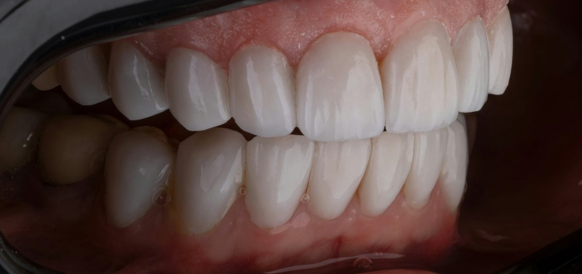 Understanding Periodontal Disease