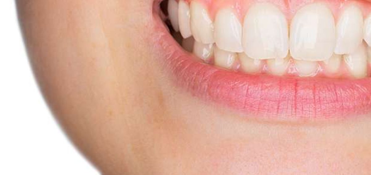 Why White Fillings Are a Better Choice Than Silver Fillings