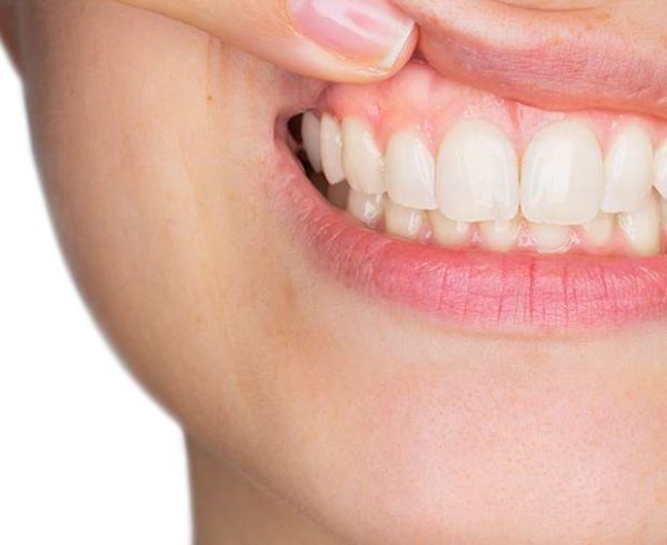Why White Fillings Are a Better Choice Than Silver Fillings